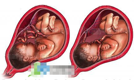 胎儿脐带异常解析图